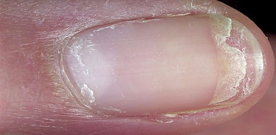 Doenças das Unhas - confira os sintomas e como tratar cada caso ...